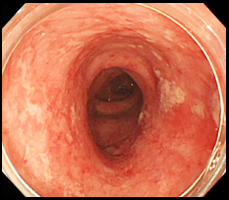 潰瘍性大腸炎の症例写真