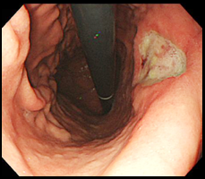 胃潰瘍の症例写真