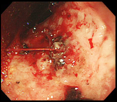 出血性胃潰瘍の症例写真
