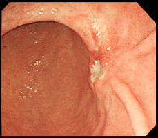胃癌の症例写真